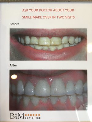 Before and After Smile makeover