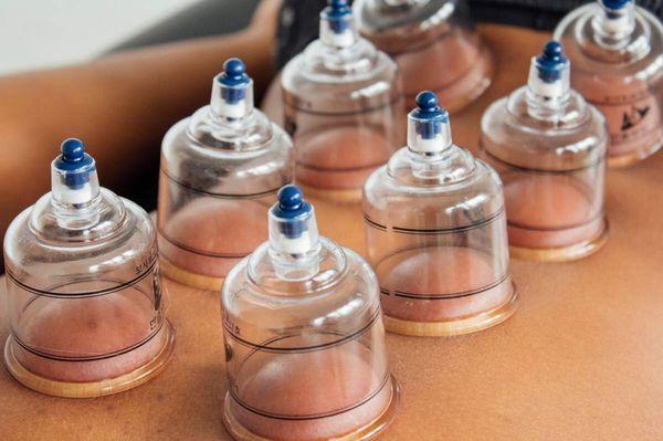 Cupping Therapy!