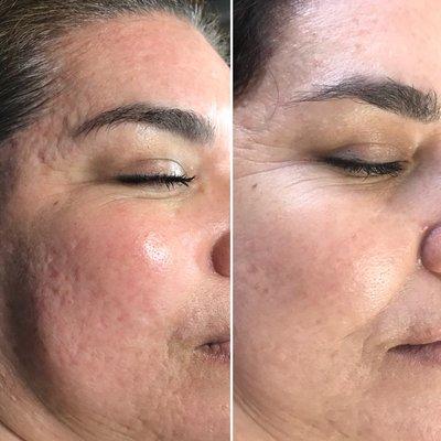 Microneedeling " collagen induction therapy" stimulate collagen to reduces fine lines, wrinkles, acne scars and pore size!!