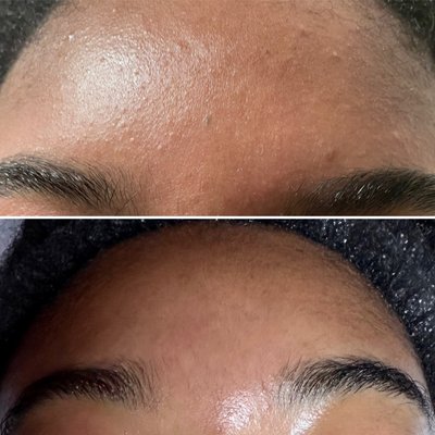 Oily/Acneic skin Facial (After 2 treatments)