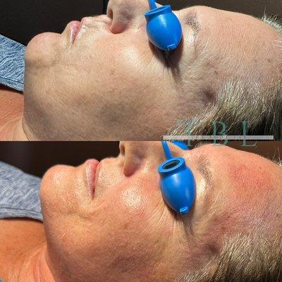 Microneedling with Age zero exesomes