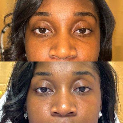 Under eye rejuvenation