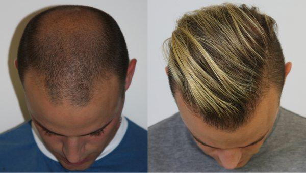 FUE Hair Transplant