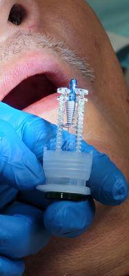 We are so proud to use Straumman Dental Implants!! They are exceptional dental implants!!!