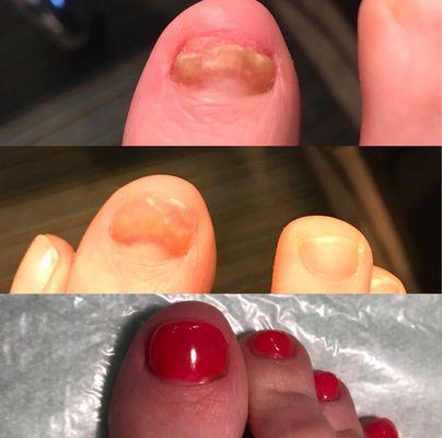 Damaged toenail repaired with acrylic overlay