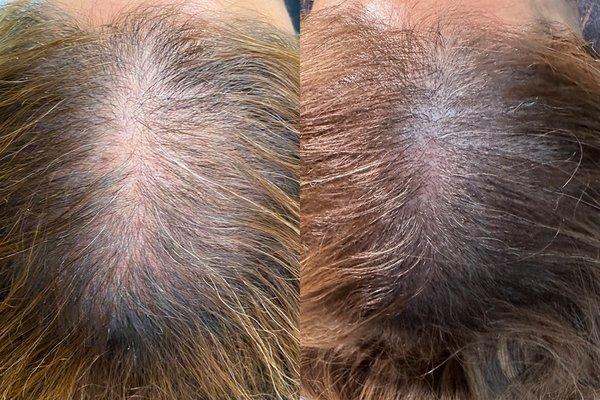 Stimulate Hair Growth with Jet Plasma! Regrowth 8 weeks after only 2 treatments.