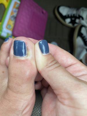 Pus filled abscess following cuticle injury at Organic Nail Spa