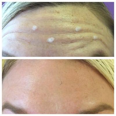 Before and after Xeomin on forehead.