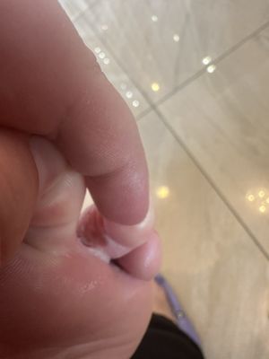 Chemical burn from pedicure service