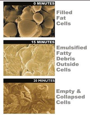 What happens o the fat cell under the ED light.