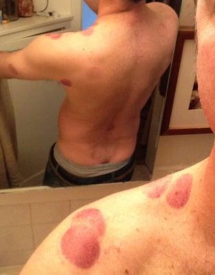 bruising from cupping administered by acupuncturist without asking my permission. bruises lasted about 10 days