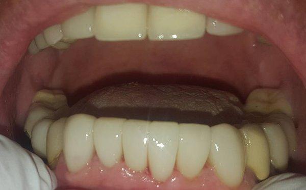 After placement of porcelain veneers! This is LIFE CHANGING!