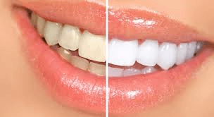 Free Whitening for Life!