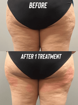 Result of 1 CryoSliming & Toning Session