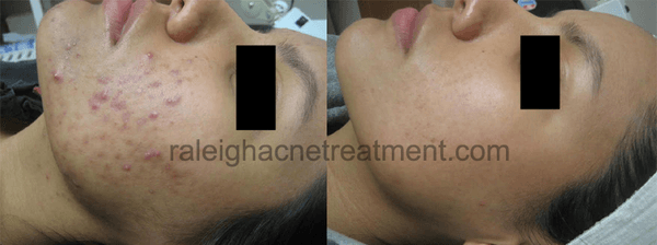 Acne Treatment results at Luminosity Acne Skincare.