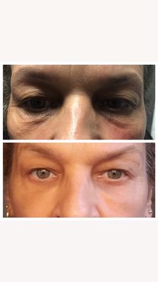 Filler correction for under eye "bags"