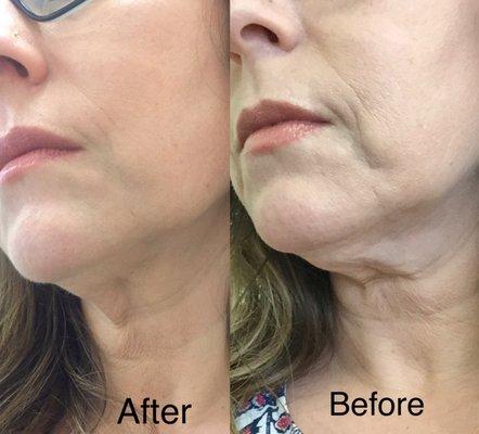 Before and after Ultherapy &cheek filler