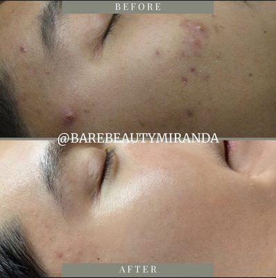 Acne Relief Treatment