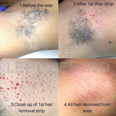 Underarm Hair Removal