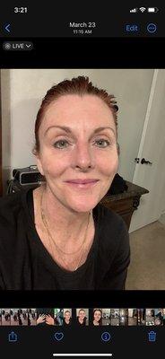 After 3 treatments no make up.