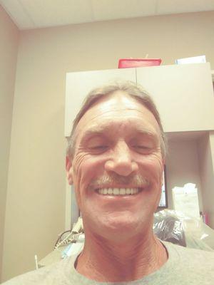 My top dentures that fit so well I don't need a drop of glue amazing