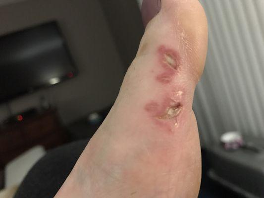 This is my foot after going to orchid nails in cathedral City! Bad !!!