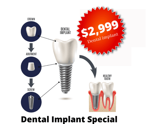 Start to finish dental implant
 *Site uncover
 *Surgical implant screw
 *Abutment
 *Zirconia implant crown
 *Implant consultation