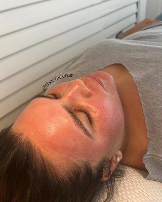 Immediately after a microneedling facial. Skin is supple and smooth.