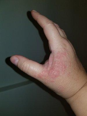 Allergic reaction to OTC pain meds used because of shortage.