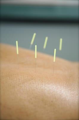 Acupuncture needles for back pain.  See how thin they are?! They don't hurt!