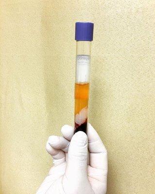 Try the Vampire faical, known as the PRP(platelet rich plasma) treatment from Ebenezer! You can see your clean plasma!