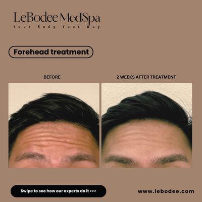 Forehead Treatment