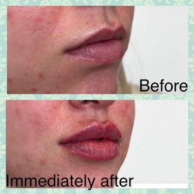 Hyaluronic acid lip filler for beautiful full natural looking lips