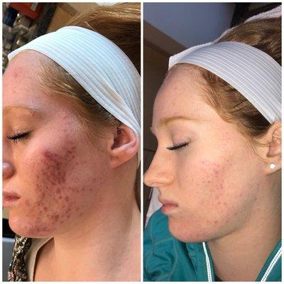 Look at the difference just after a few weeks and treatments!