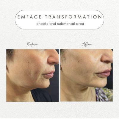 Emface non-surgical facelift procedure.