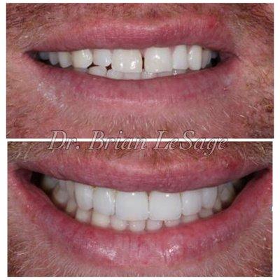 Porcelain veneers