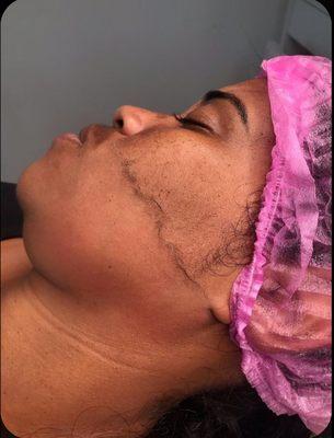 Dermaplaning facial process