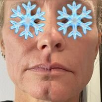 Cryo Facial Results