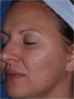 Acne & Scar Reduction Treatment After