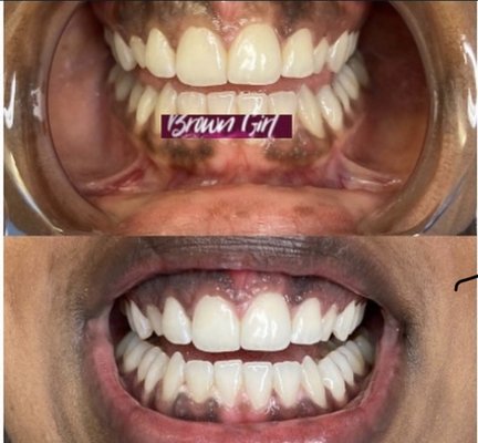 Before & After 1 hour laser teeth whitening session.