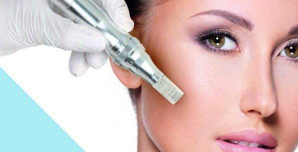 Microneedling Treatment