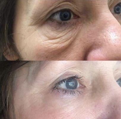 Fibroblast skin tightening under eye treatment