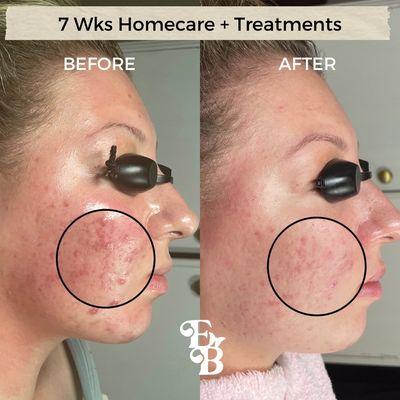 7 weeks acne bootcamp