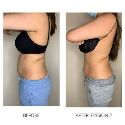 Body Sculpting results after two treatments