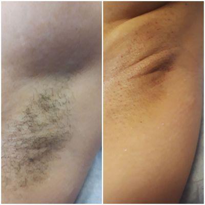 Underarm Wax