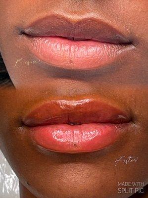 Lip Neutralization