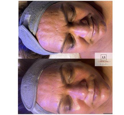 Before and Immediately After The Works HydraFacial with Britenol