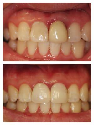 Before and After of Metal Free Crown Replacement