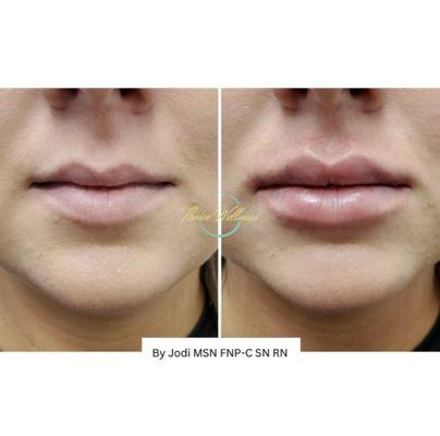 Lip Filler: 600
We carry Juvederm, Restylane, Versa, RHA, and many others. We can provide injections at the medical spa to meet your needs.