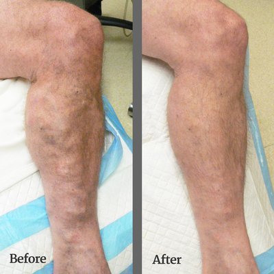 The varicose veins of the patient were treated with Venefit by Dr. Raffi Dishakjian.